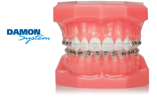 Damon Self-Ligating System